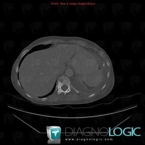 Metastasis, Vertebral body / Disk, CT