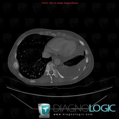 Metastasis, Vertebral body / Disk, CT