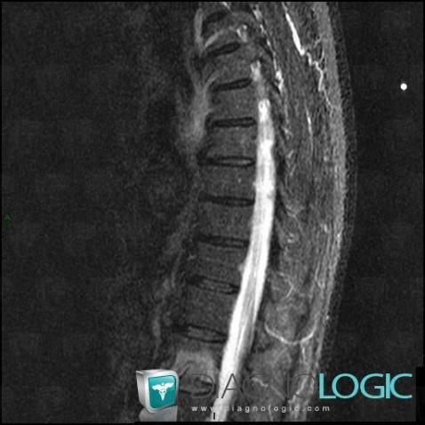 Metastasis, Vertebral body / Disk, MRI