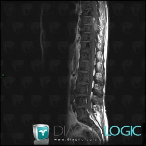 Metastasis, Vertebral body / Disk, MRI