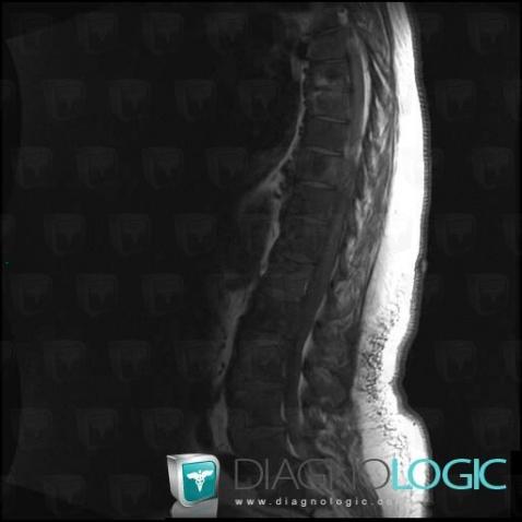 Metastasis, Vertebral body / Disk, MRI