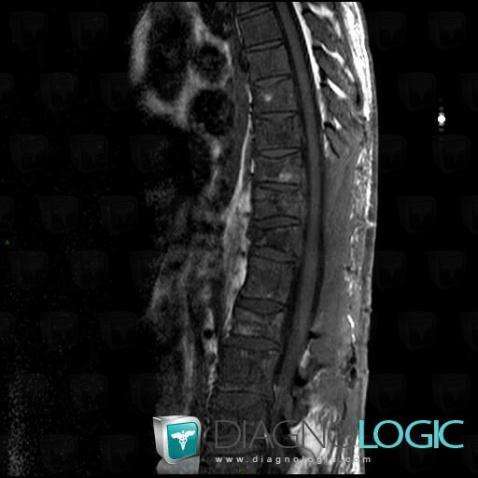 Metastasis, Vertebral body / Disk, MRI