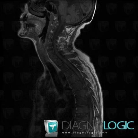 Metastasis, Vertebral body / Disk, MRI