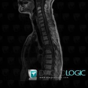 Metastasis, Vertebral body / Disk, MRI