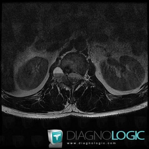 Metastasis, Vertebral body / Disk, MRI