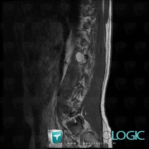 Metastasis, Vertebral body / Disk, MRI