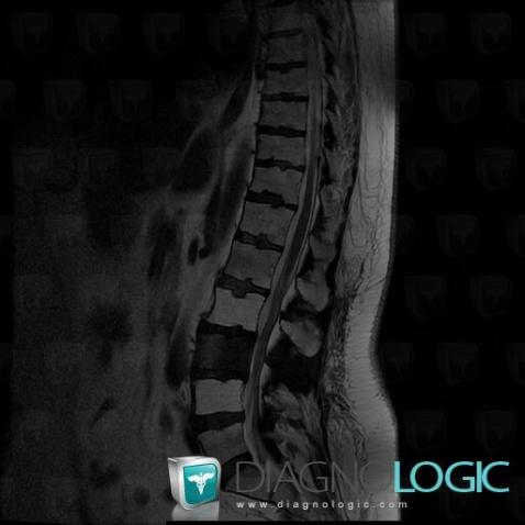 Metastasis, Vertebral body / Disk, MRI