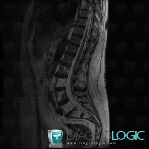 Metastasis, Vertebral body / Disk, MRI