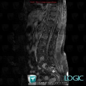 Metastasis, Vertebral body / Disk, MRI