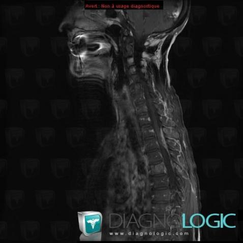 Metastasis, Vertebral body / Disk, MRI