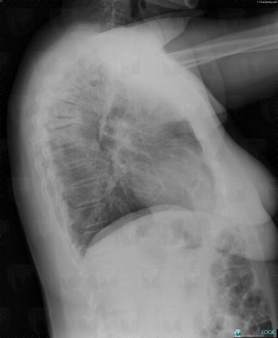 Metastasis, Vertebral body / Disk, X rays