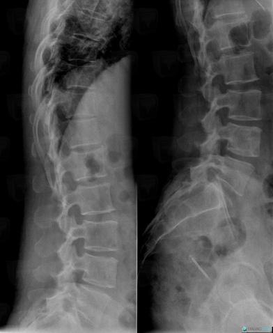 Metastasis, Vertebral body / Disk, X rays