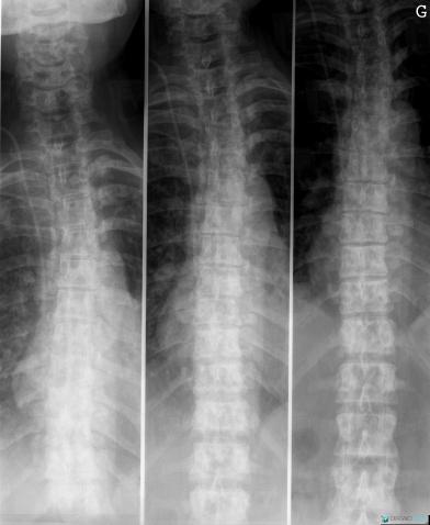 Radiology case : Metastasis (X rays) - Diagnologic