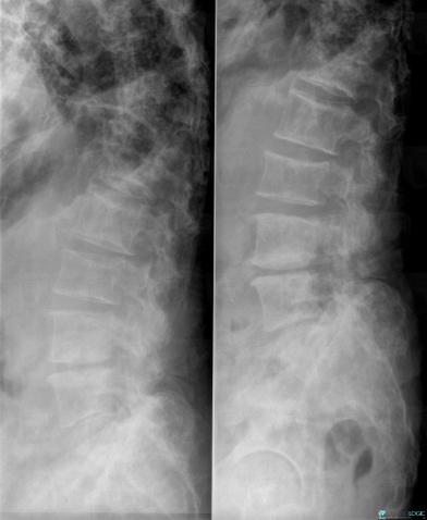 Metastasis, Vertebral body / Disk, X rays