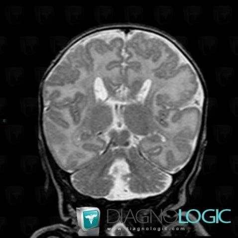 Micropolygyria, Cortico subcortical region, Cerebral hemispheres, MRI