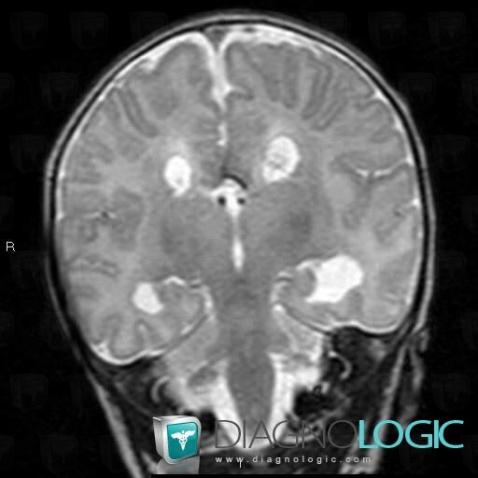 Micropolygyria, Cortico subcortical region, Cerebral hemispheres, MRI