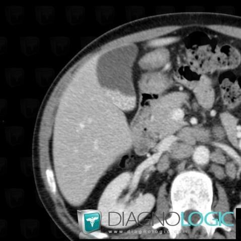 Milk-calcium bile, Gallbladder, CT