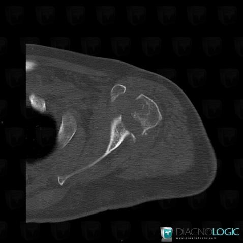 Milwaukee shoulder, Humerus - Proximal part, CT