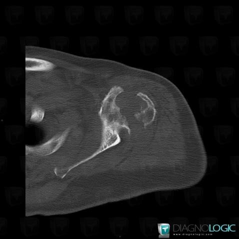 Milwaukee shoulder, Scapula, CT