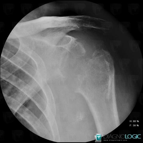 Milwaukee shoulder, Scapula, Humerus - Proximal part, X rays