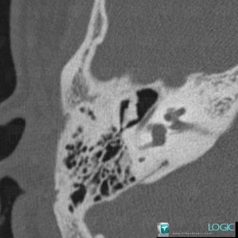 Minor aplasia, Middle ear, CT