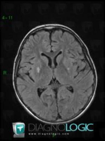 Mitochondrial cytopathy, Basal ganglia and capsule, MRI