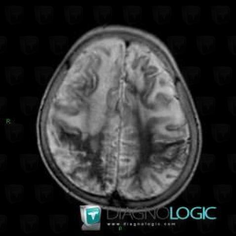 Mitochondrial cytopathy, Basal ganglia and capsule, Theoretical