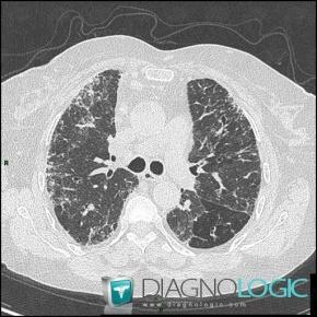 Mixed connective tissue disease, Pulmonary parenchyma, CT
