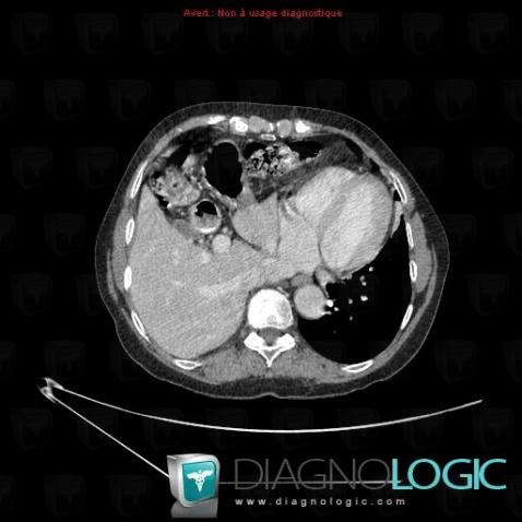 Morgagni's hernia, Diaphragm, CT