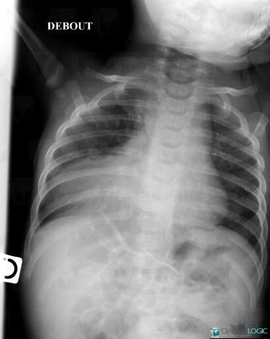 Morgagni's hernia, Diaphragm, X rays