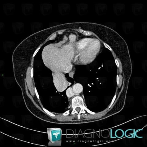 Morgagni's hernia, Mediastinum, CT