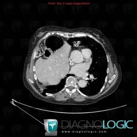 Morgagni's hernia, Mediastinum, CT