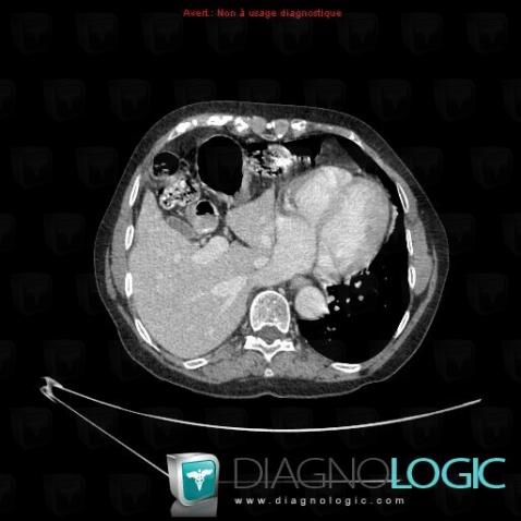 Morgagni's hernia, Mediastinum, CT