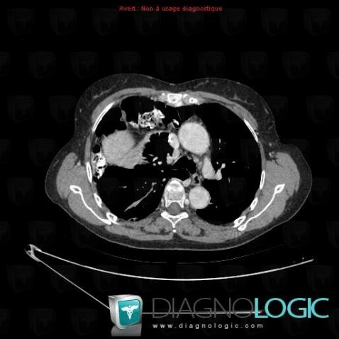 Morgagni's hernia, Mediastinum, CT