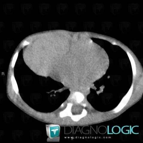 Morgagni's hernia, Mediastinum, CT