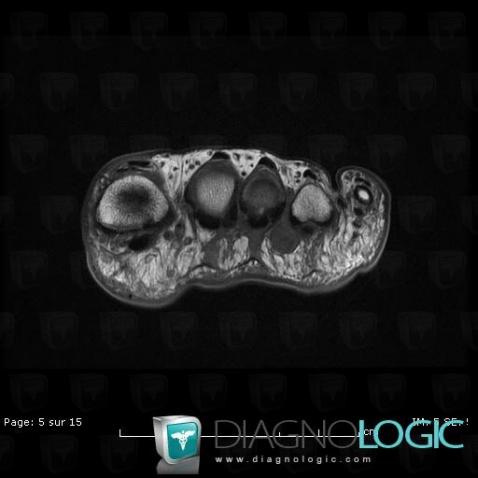 Morton's neuroma, Other soft tissues/nerves - Foot, MRI