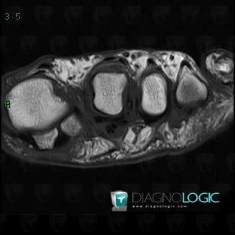 Morton's neuroma, Other soft tissues/nerves - Foot, MRI