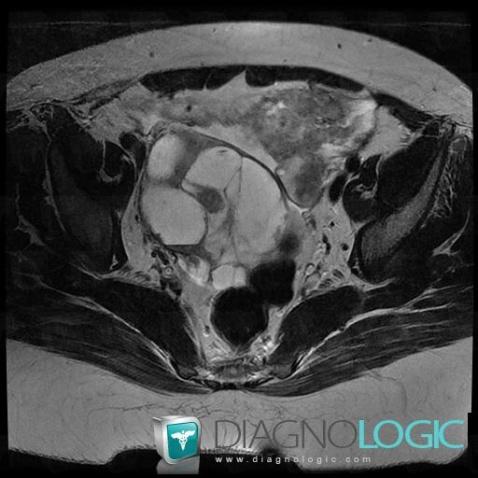 Mucinous cystadenocarcinoma, Adnexa / Ovary fallopian tube, MRI