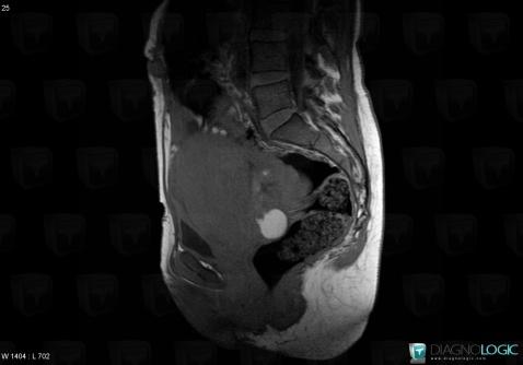 Mucinous cystadenocarcinoma, Adnexa / Ovary fallopian tube, MRI