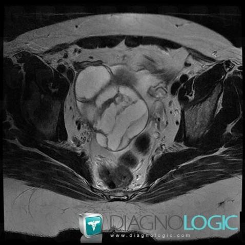 Mucinous cystadenocarcinoma, Pelvis / Perineum, MRI