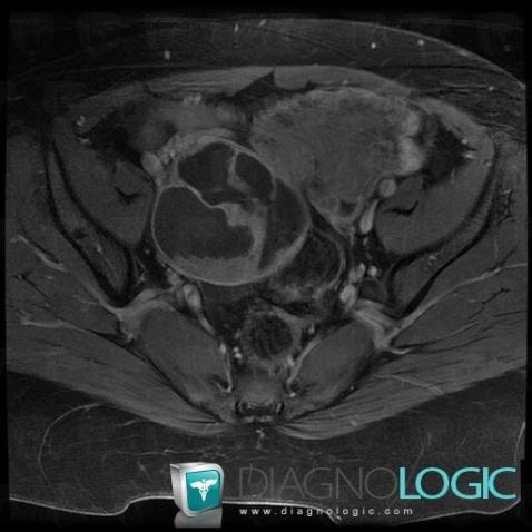 Mucinous cystadenocarcinoma, Pelvis / Perineum, MRI