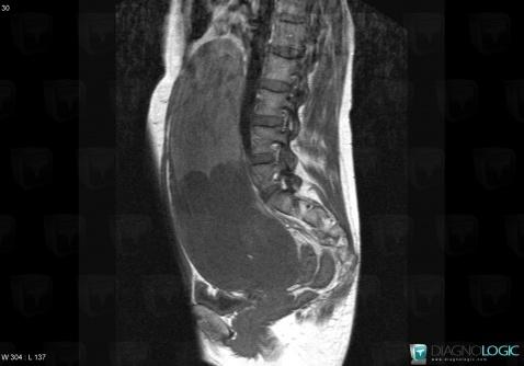 Mucinous cystadenoma, Adnexa / Ovary fallopian tube, MRI