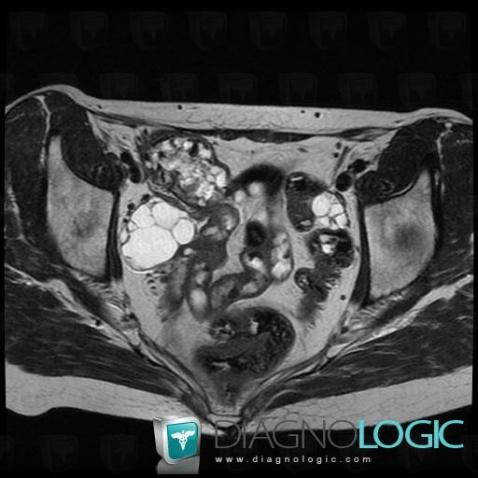 Mucinous cystadenoma, Adnexa / Ovary fallopian tube, Pelvis / Perineum, MRI