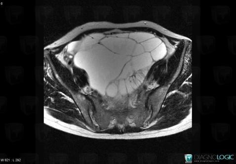 Mucinous cystadenoma, Adnexa / Ovary fallopian tube, Pelvis / Perineum, MRI