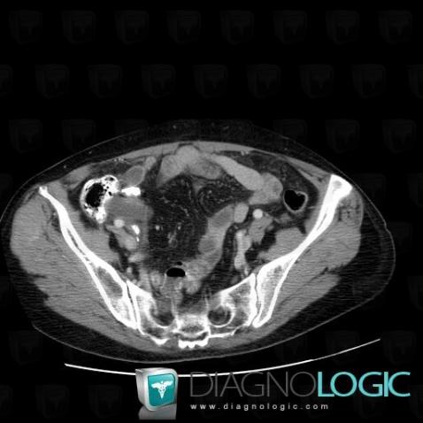 Mucocele, Caecum / Appendix, CT