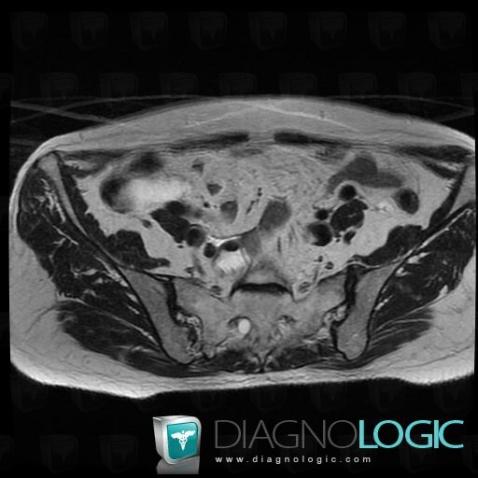 Mucocele, Caecum / Appendix, MRI