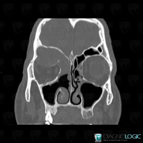 Mucocele, Eye, Sinus, CT