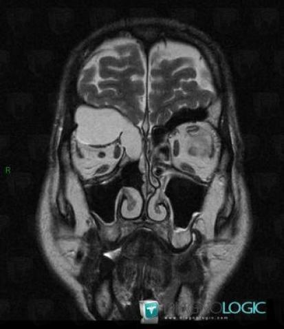 Mucocele, Eye, Sinus, MRI