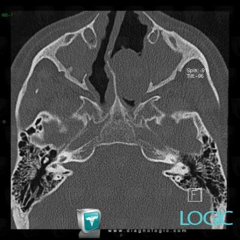 Mucocele, Nasal cavity / Nasopharynx, CT