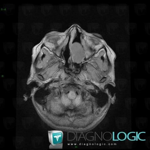 Mucocele, Nasal cavity / Nasopharynx, MRI